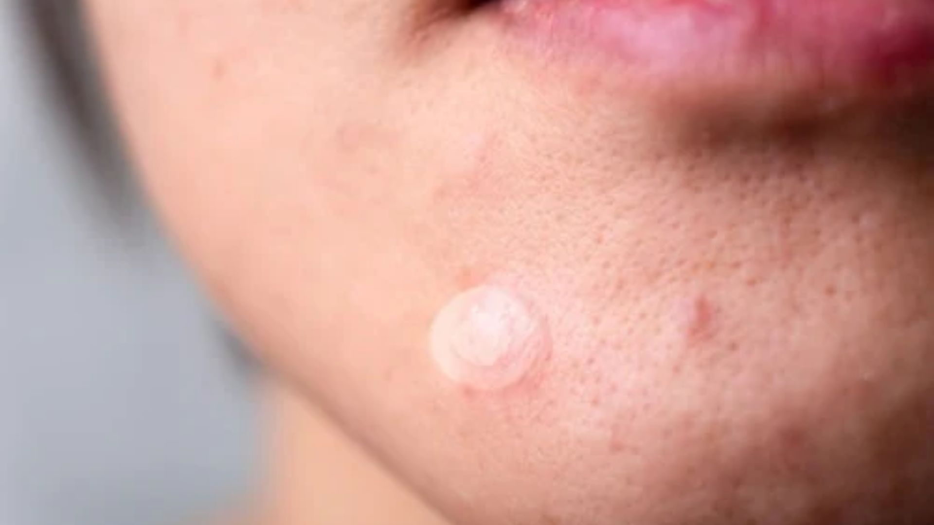 Close-up of a person's chin with a transparent acne patch on a spot. The skin shows mild texture and blemishes, conveying a focus on skincare.