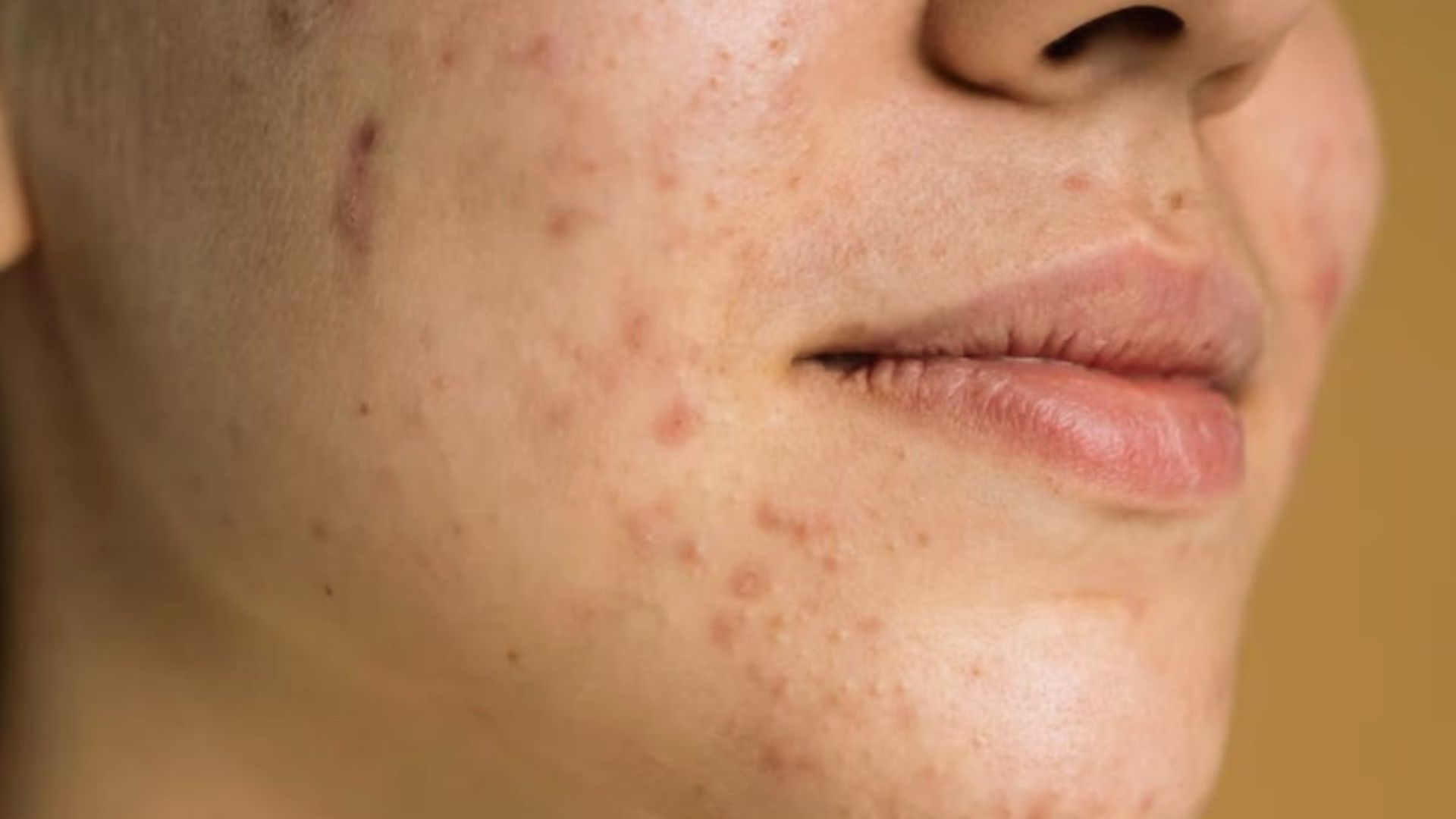 Close-up of a person's cheek and lips with visible acne and blemishes. The skin has various red spots. The lighting is warm, providing a neutral tone.