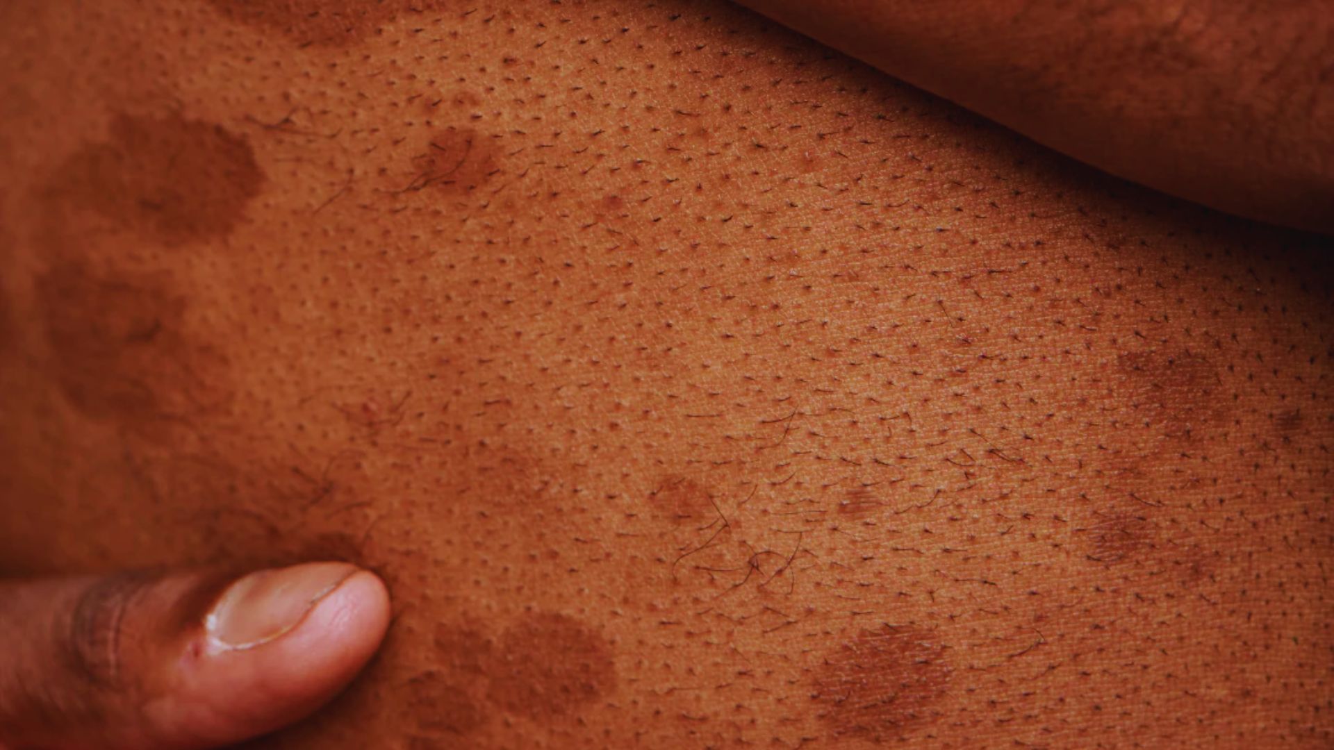 Close-up of skin with visible pores and dark spots, possibly indicating hyperpigmentation. A hand gently touches the skin, conveying care and sensitivity.