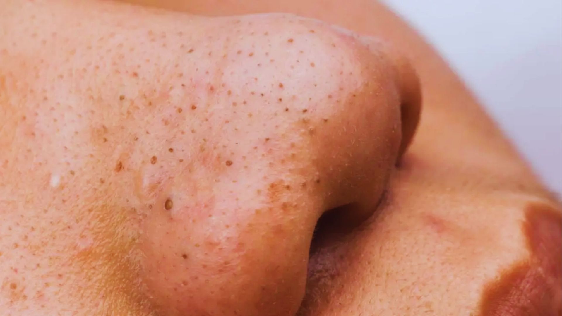 Close-up of a person's nose with visible blackheads and pores. The skin appears uneven in texture. The image suggests skincare concerns.