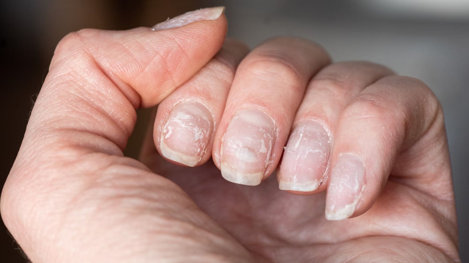 A close-up of a hand showing fingernails with peeling, damaged layers, indicating a possible need for nail care. The skin appears slightly dry.