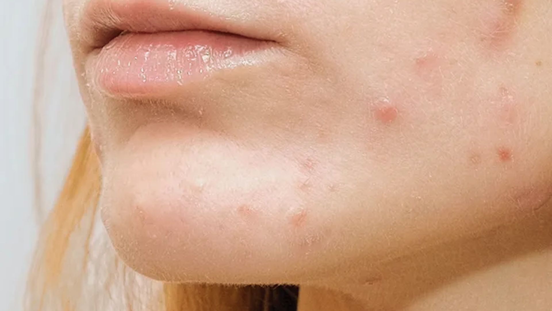 Close-up of a person's chin and lips with visible acne and redness. The skin shows multiple small blemishes, conveying a sense of sensitivity.