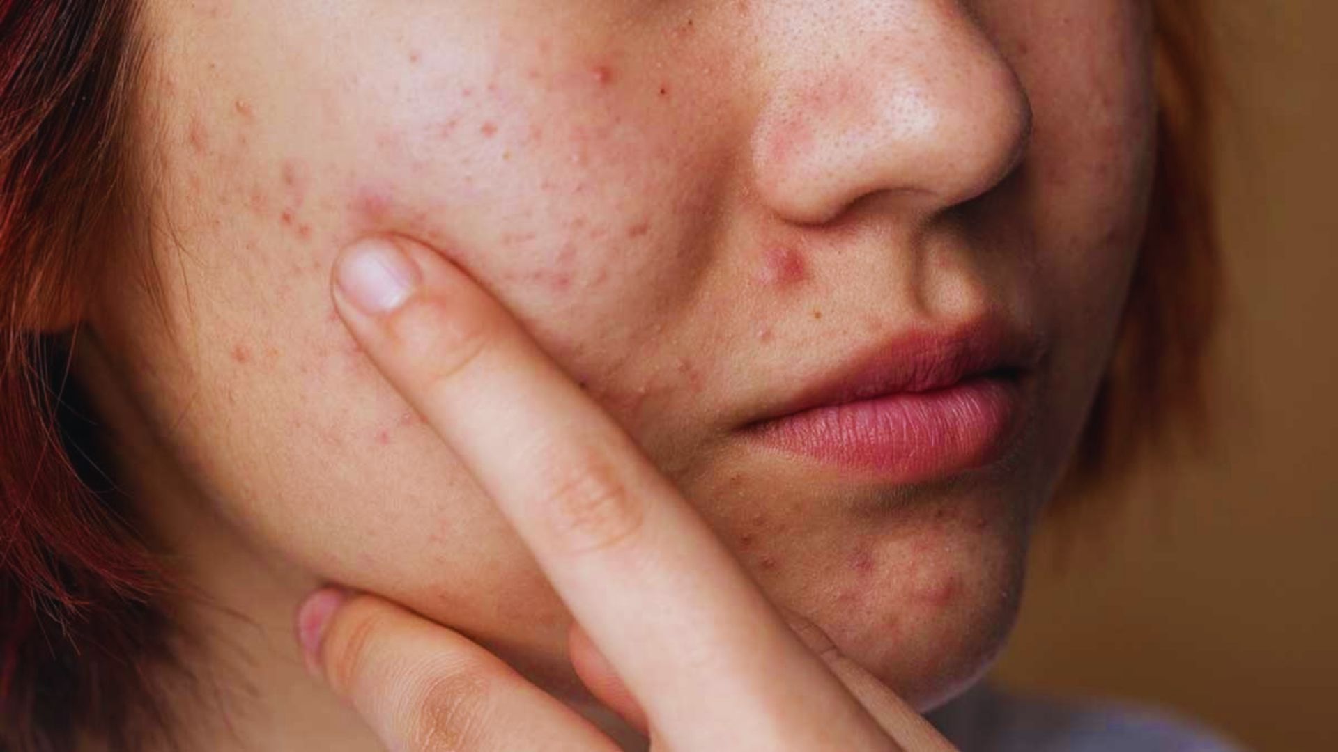 Close-up of a person's cheek with acne and a finger gently touching the skin. The image conveys a sense of concern and focuses on skin texture.