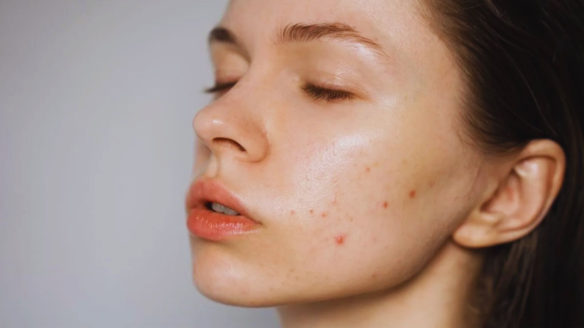 A close-up of a person's face with closed eyes, showcasing a clear complexion with some acne spots on the cheek. The expression is calm and serene.