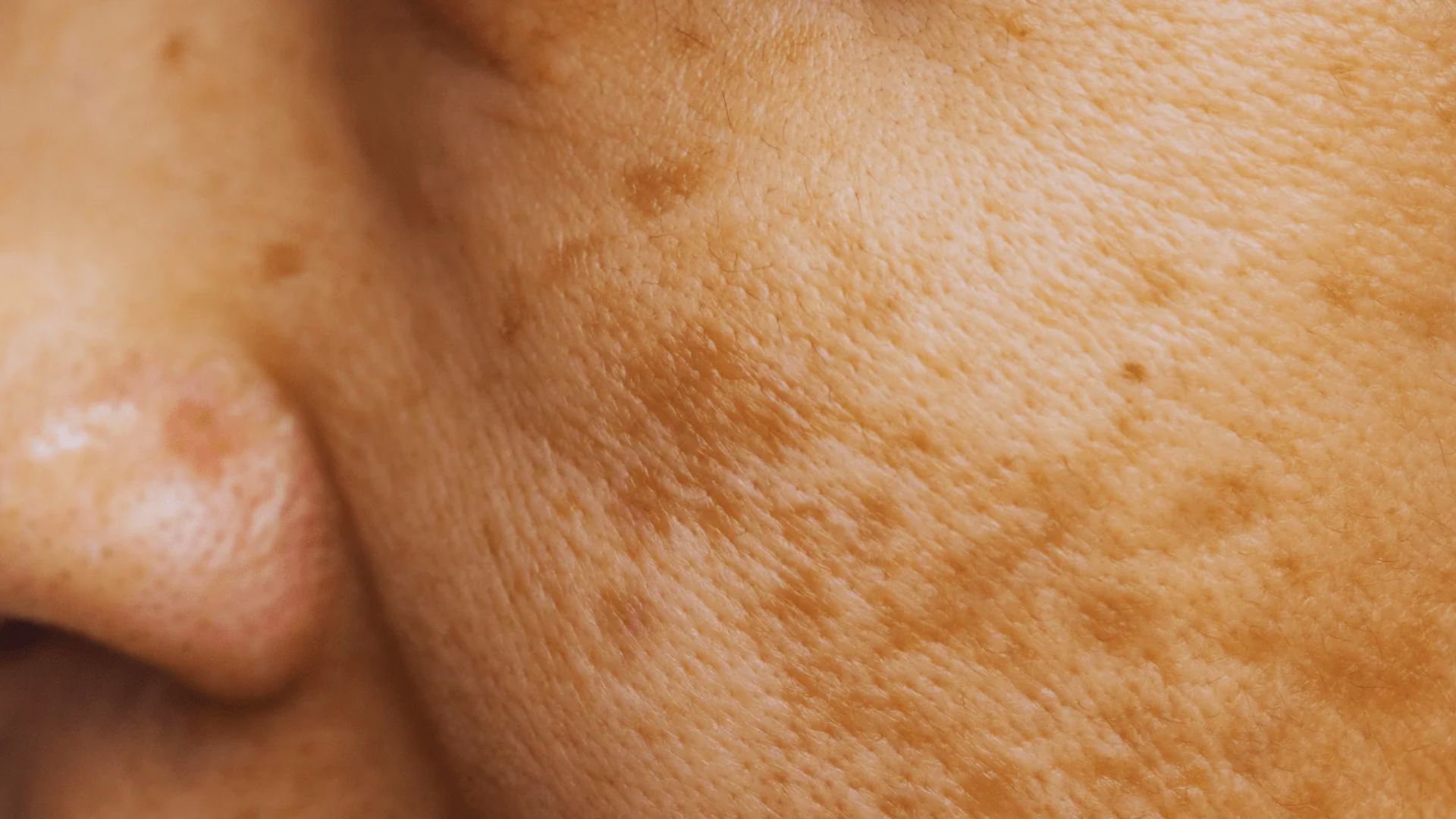 Close-up of a person's cheek showing skin texture with visible pores and brown spots. The tone is neutral, highlighting natural skin details.