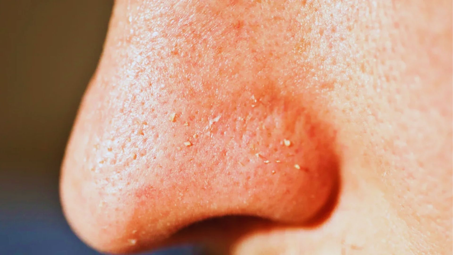 Close-up of a person's nose with visible blackheads and dry, flaky skin. The skin appears reddish, suggesting irritation or dryness.