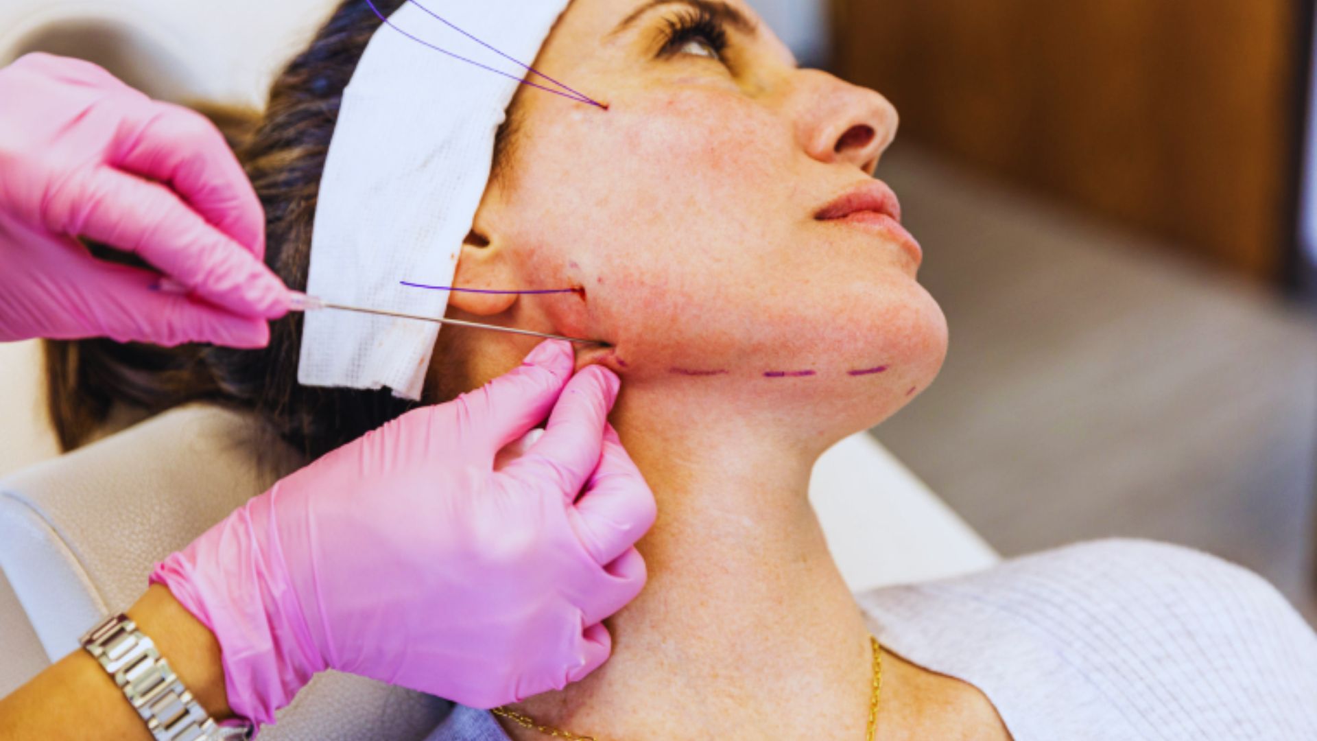 A woman reclines during a cosmetic procedure with blue threads on her face. A professional in pink gloves applies treatment to her jawline.