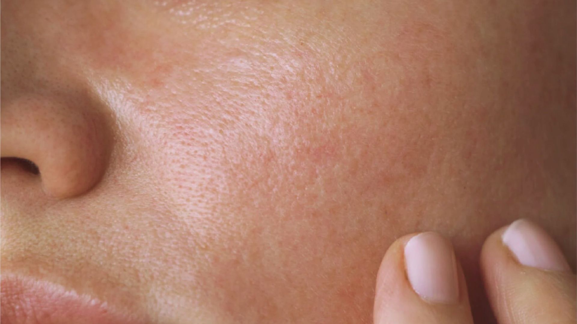 Close-up of a person's cheek, showing visible pores and a slight reddish tone. A finger gently touches the skin, emphasizing its texture.