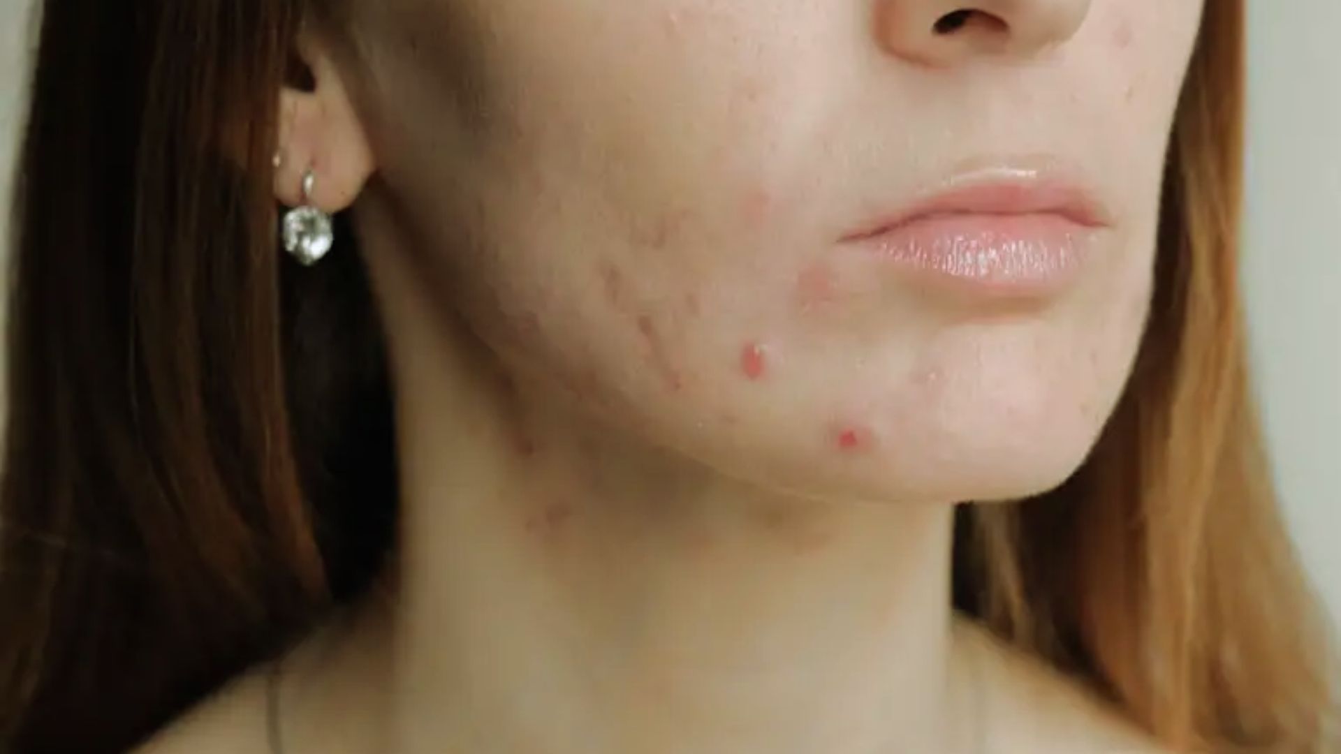 Close-up of a woman's lower face with acne on her chin and jawline. Her skin appears slightly inflamed, and she wears a small earring. The tone is neutral.