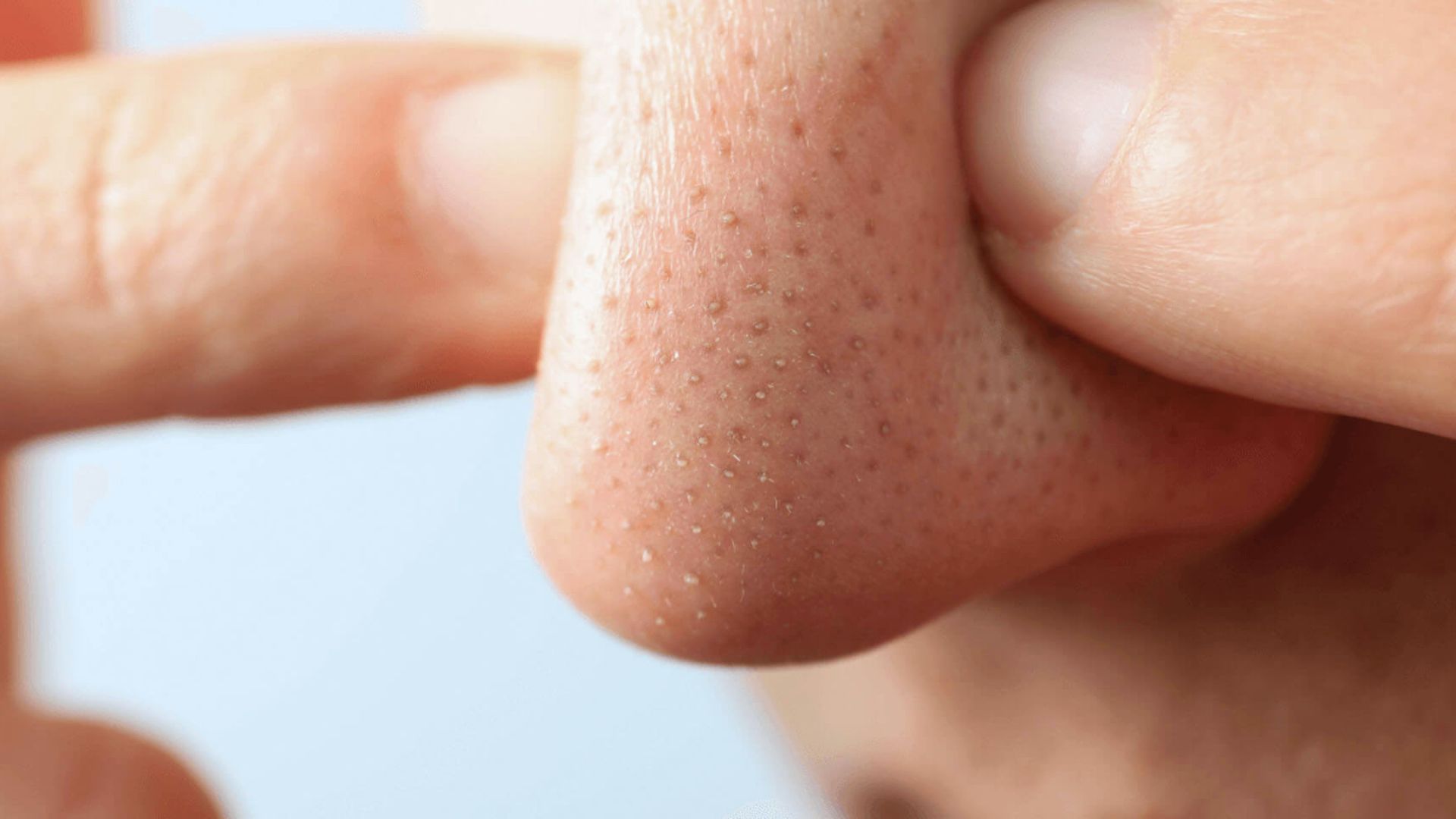 Close-up of a person's nose with visible blackheads. A finger is shown pressing gently on the skin. The image conveys skincare attention.