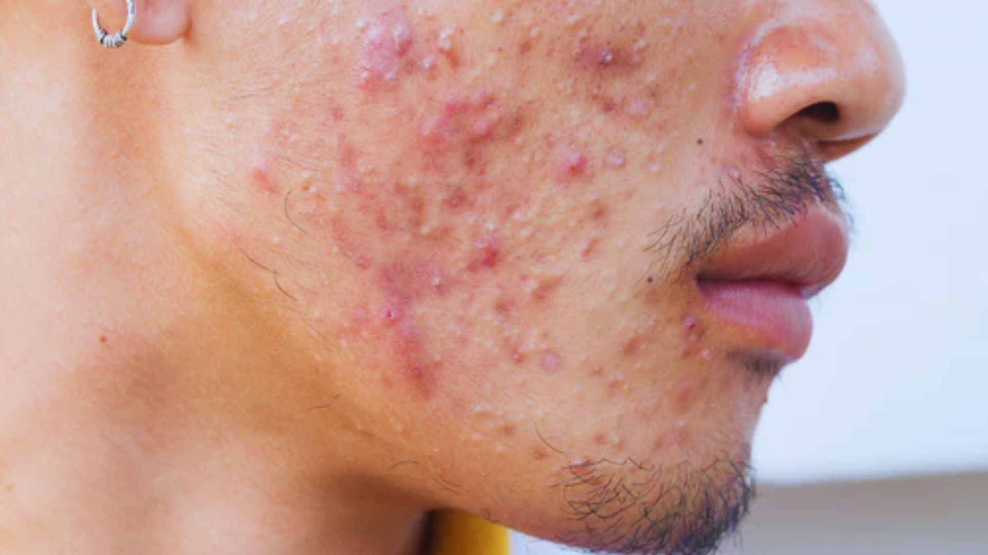 Close-up of a person's cheek with acne, showing red, inflamed blemishes. The skin appears textured and irritated, conveying a sense of discomfort.