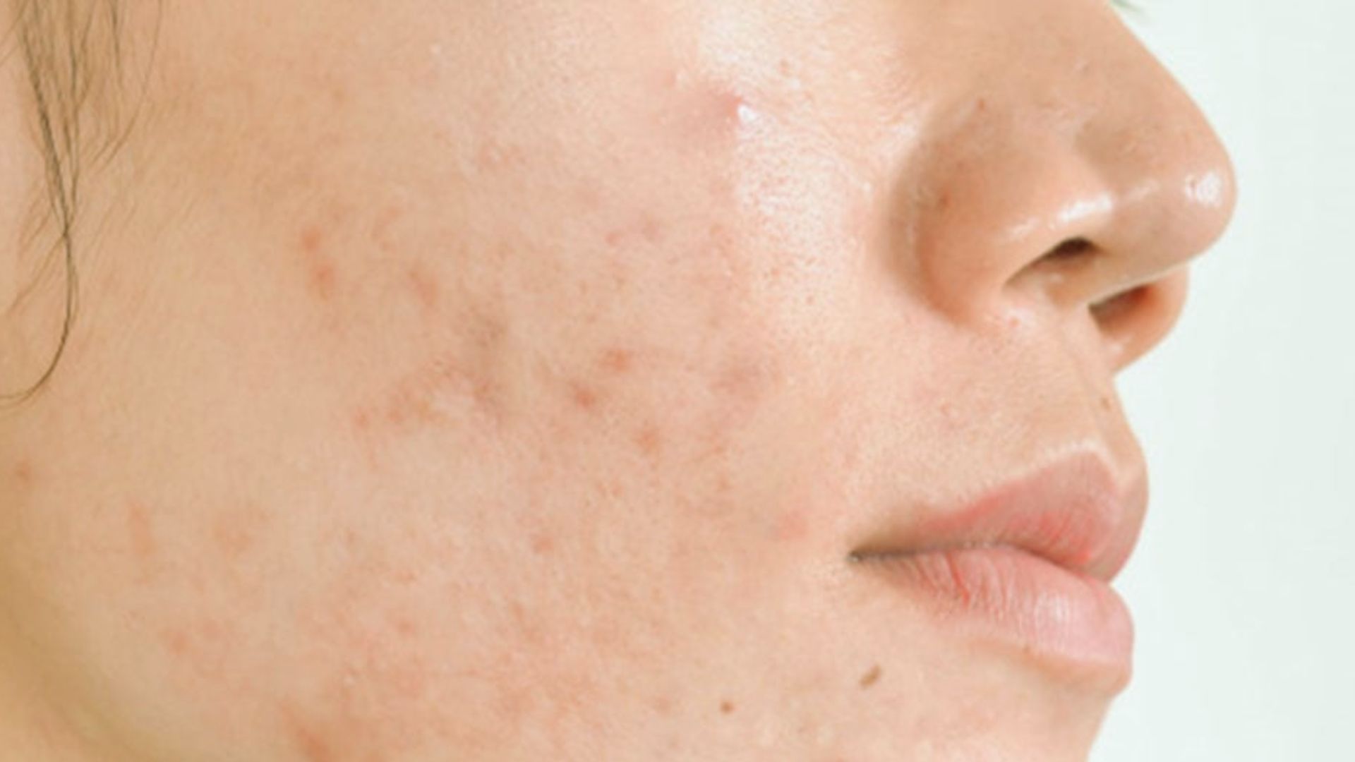 Close-up of a person's cheek showing acne scars and blemishes. The skin texture is uneven, conveying a sense of vulnerability and natural imperfection.