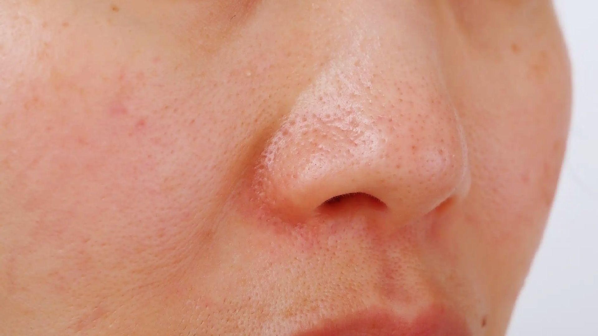 Close-up of a person's nose and cheek with visible pores and subtle blemishes. The skin has a natural texture and a slightly rosy tone.