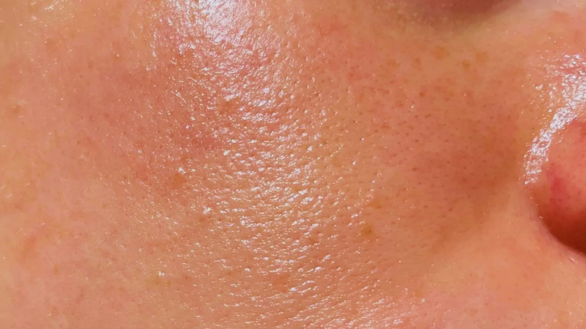 Close-up of textured skin showcasing visible pores and a slightly shiny surface. The area has a natural, slightly pink hue, emphasizing realistic skin detail.