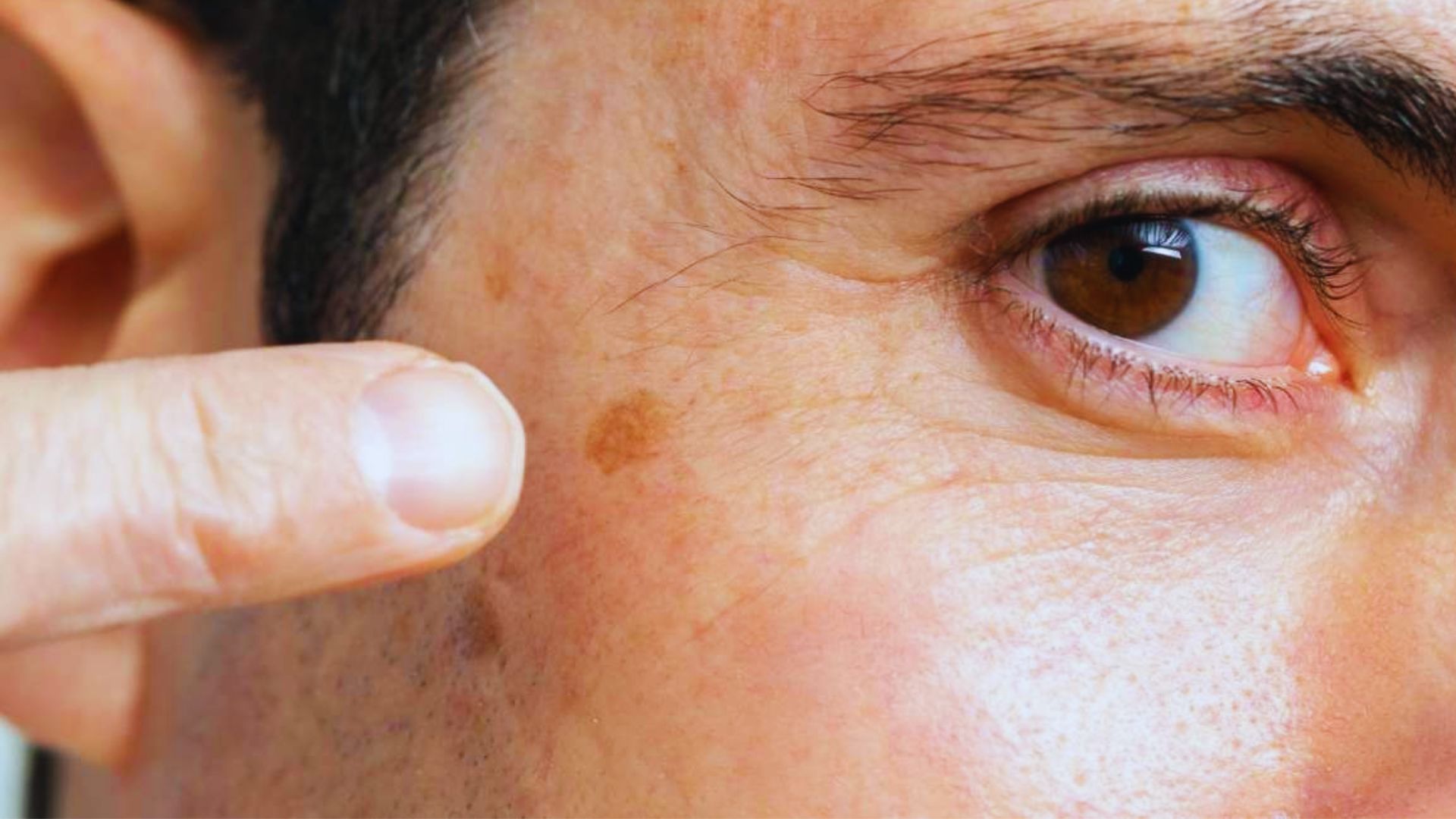 Close-up of a person pointing to a brown mole near their eye. The skin appears smooth, with a focused expression. Keywords: mole, skin, close-up.