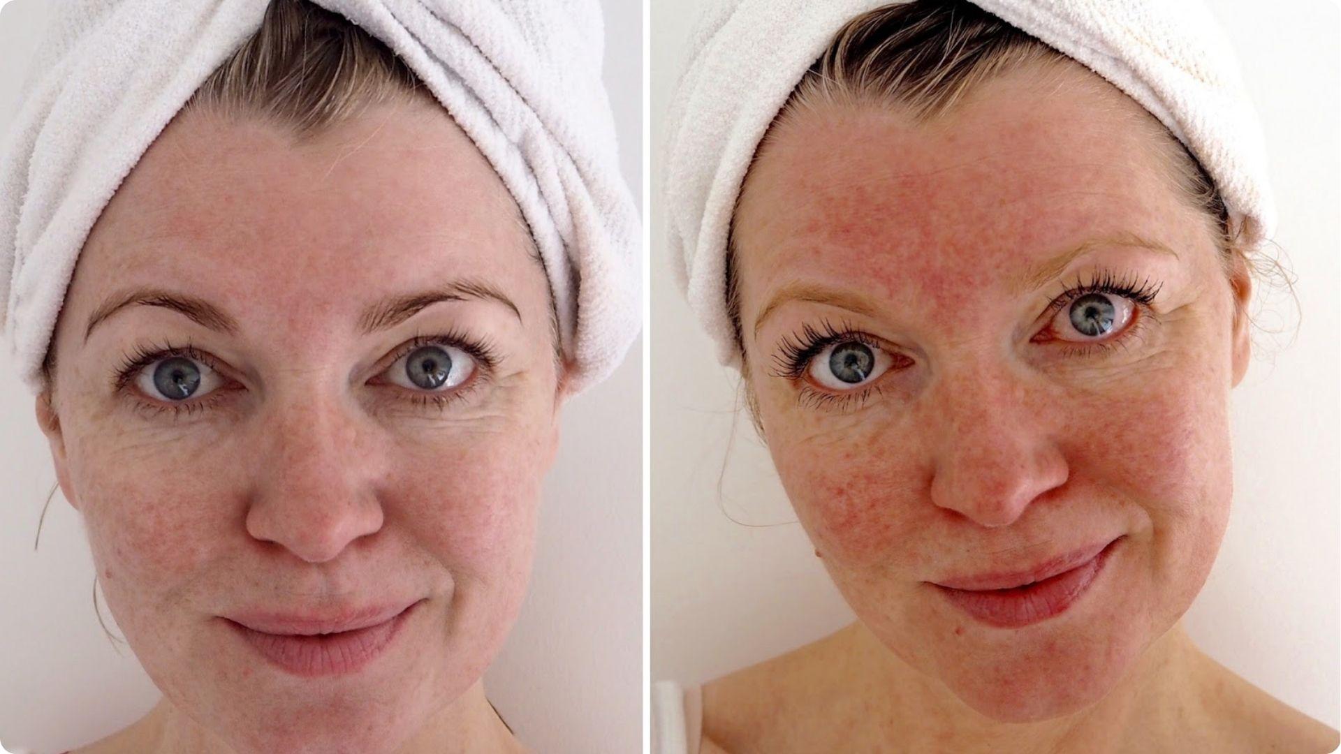 Side-by-side before and after comparison of a woman’s face with a towel wrapped around her hair.