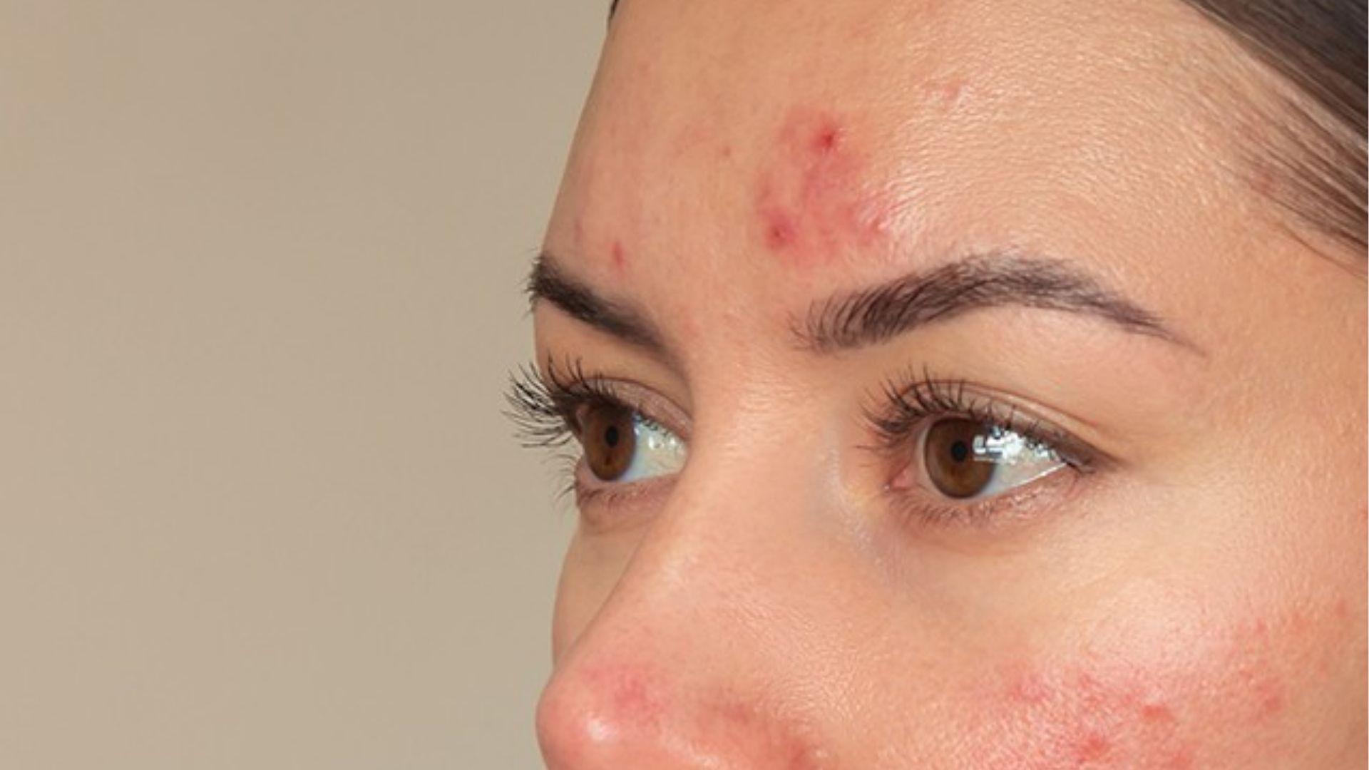 Close-up of forehead and cheek acne showing red, inflamed pimples often triggered by high stress.