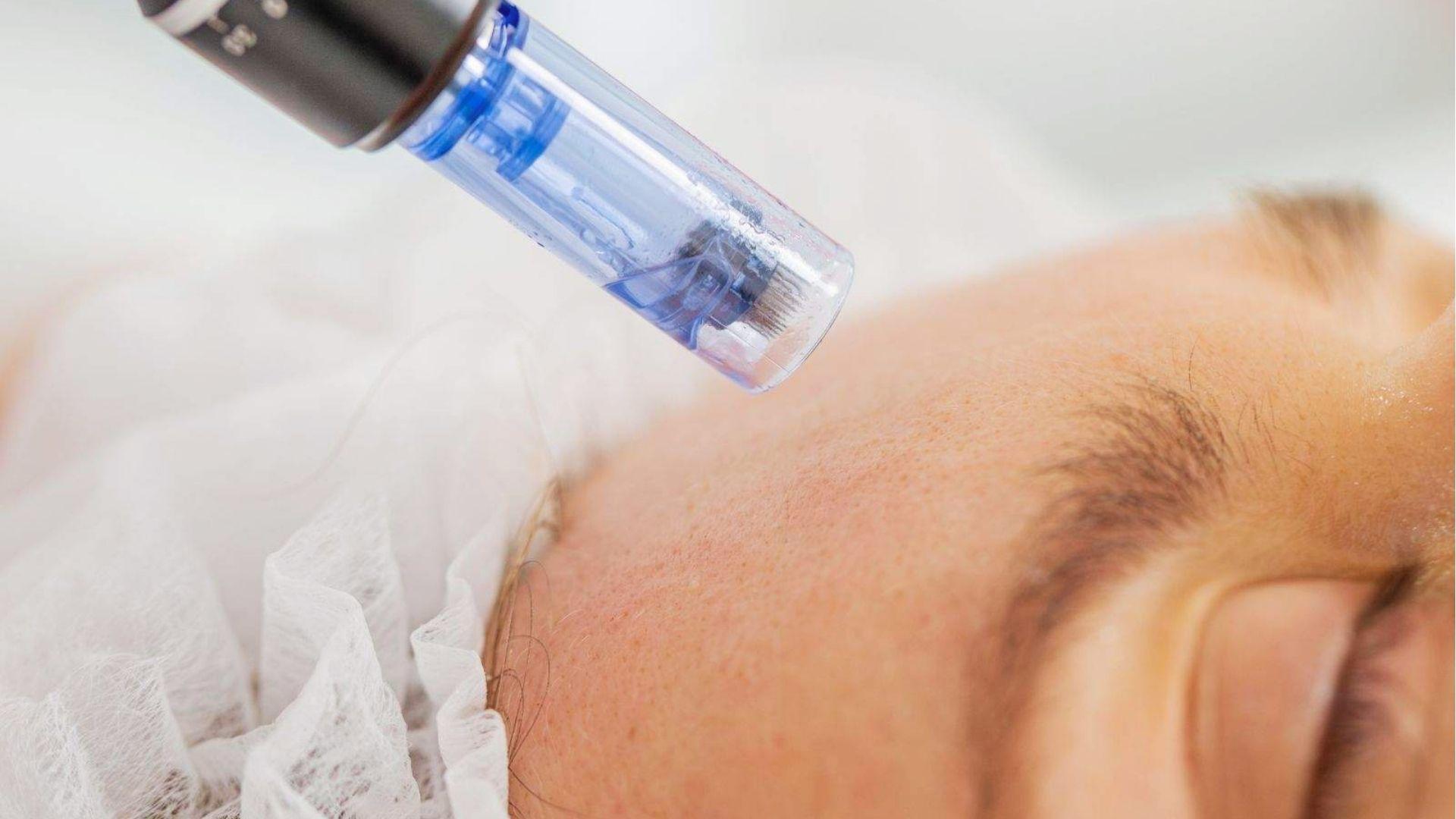 Close-up of microneedling pen treating forehead skin to reduce acne scars and boost collagen production