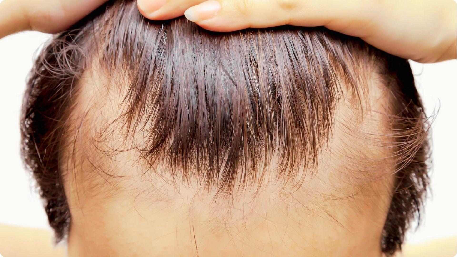 Top-down view of a person lifting hair to show sparse density along the frontal hairline.