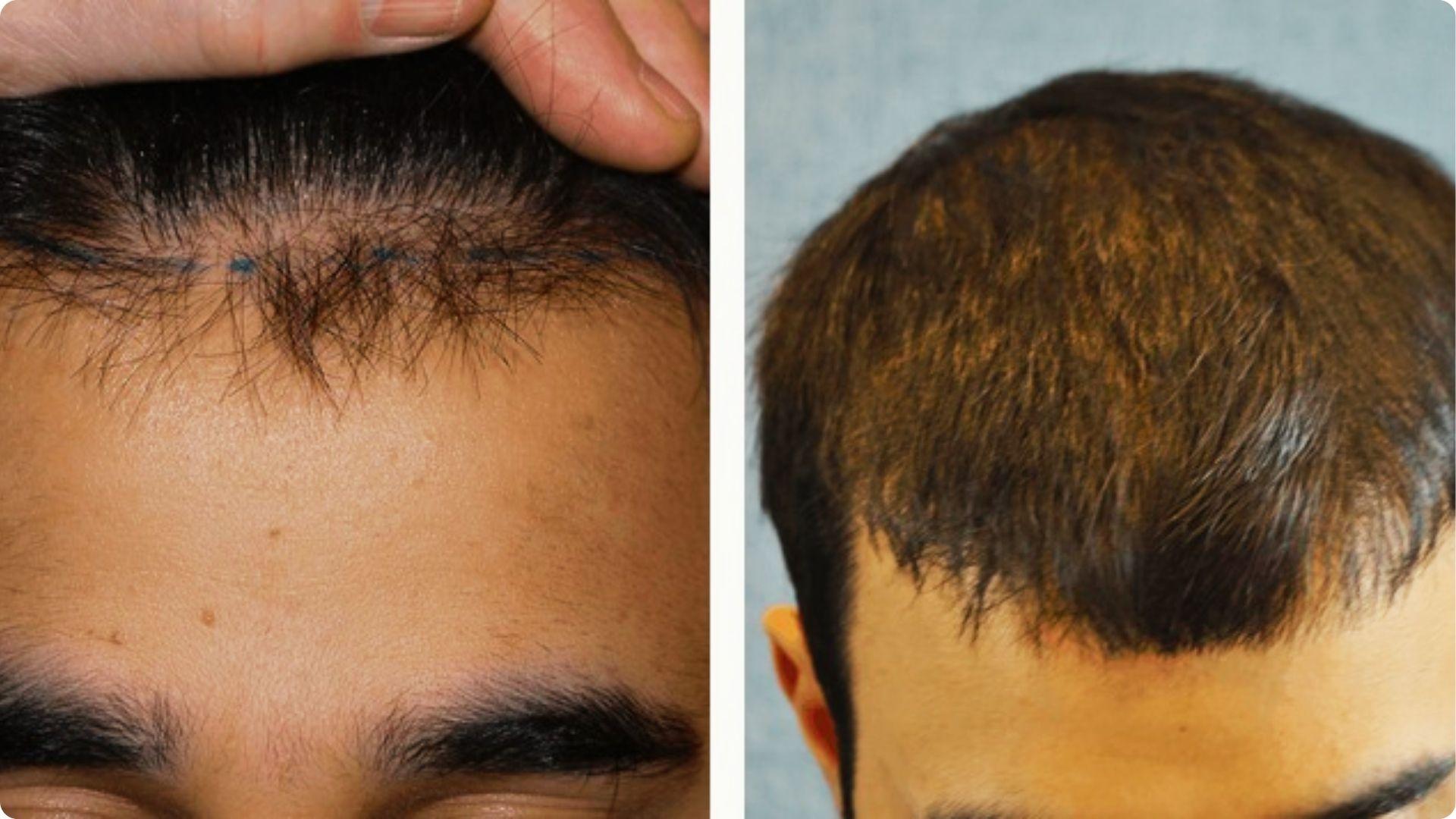 Split comparison of two hairlines: left shows a sparse, marked hairline with blue dots, right shows a dense, even hairline.