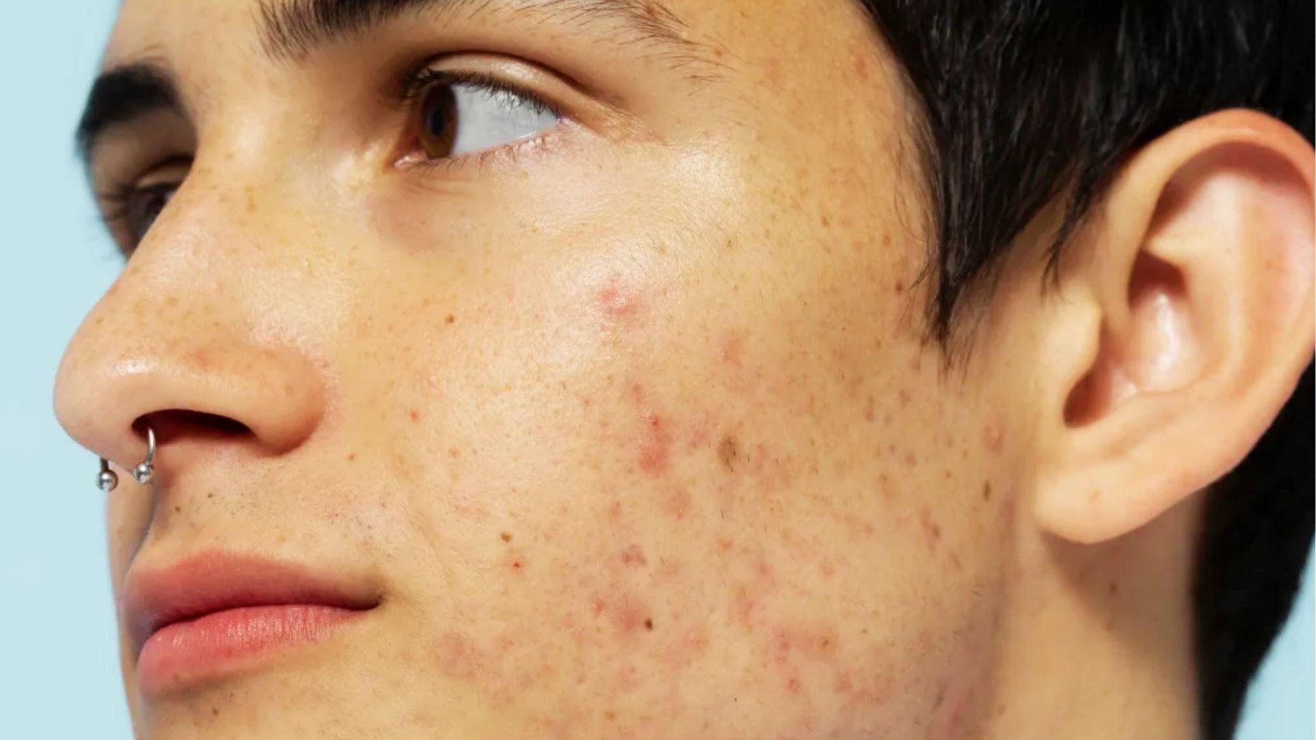 Close-up of cheek with red acne marks and post-inflammatory hyperpigmentation needing treatment to fade scars