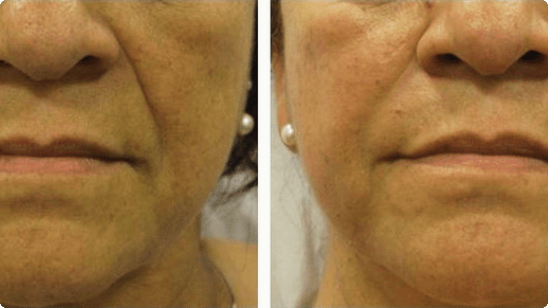 Before and after close-up of the lower face showing softening of nasolabial folds and improved skin plumpness.