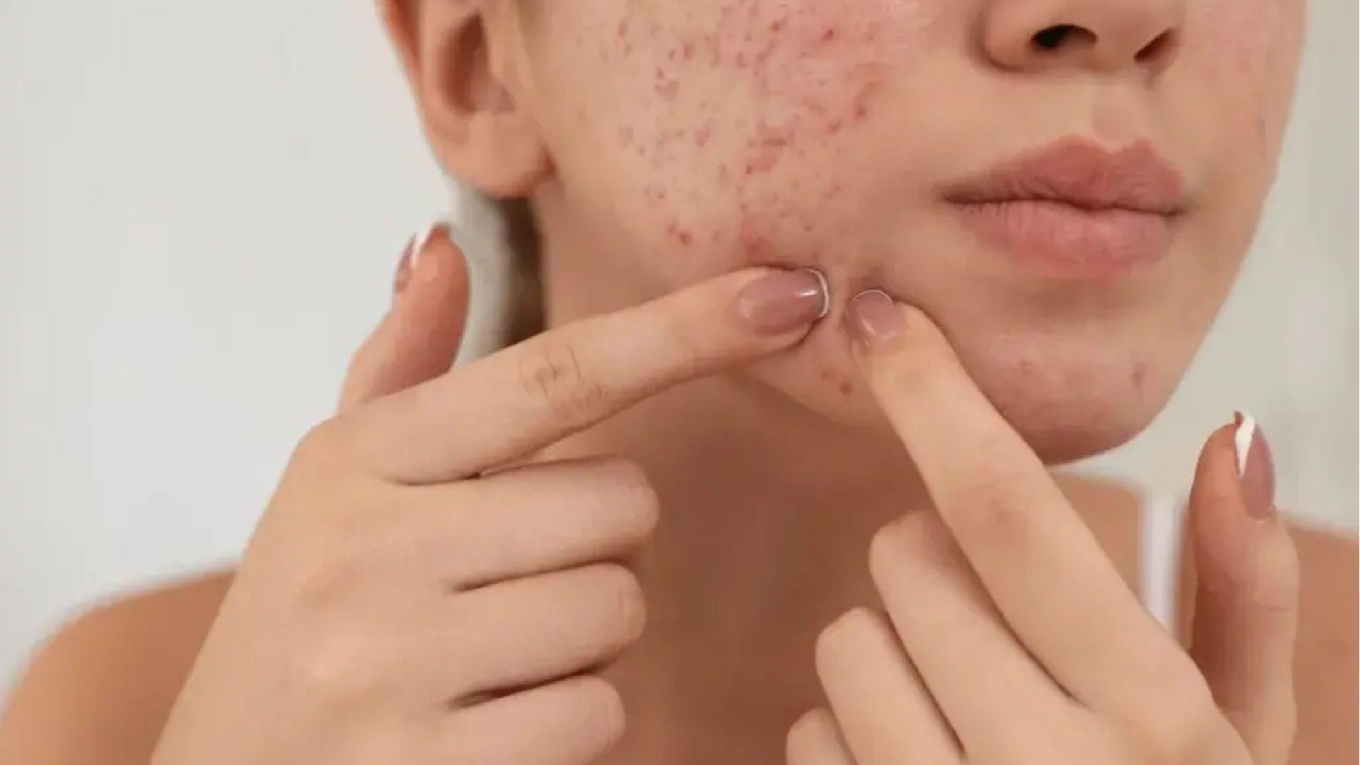 Woman pinches a chin pimple while checking acne flare-up, a common reaction to stress breakouts.