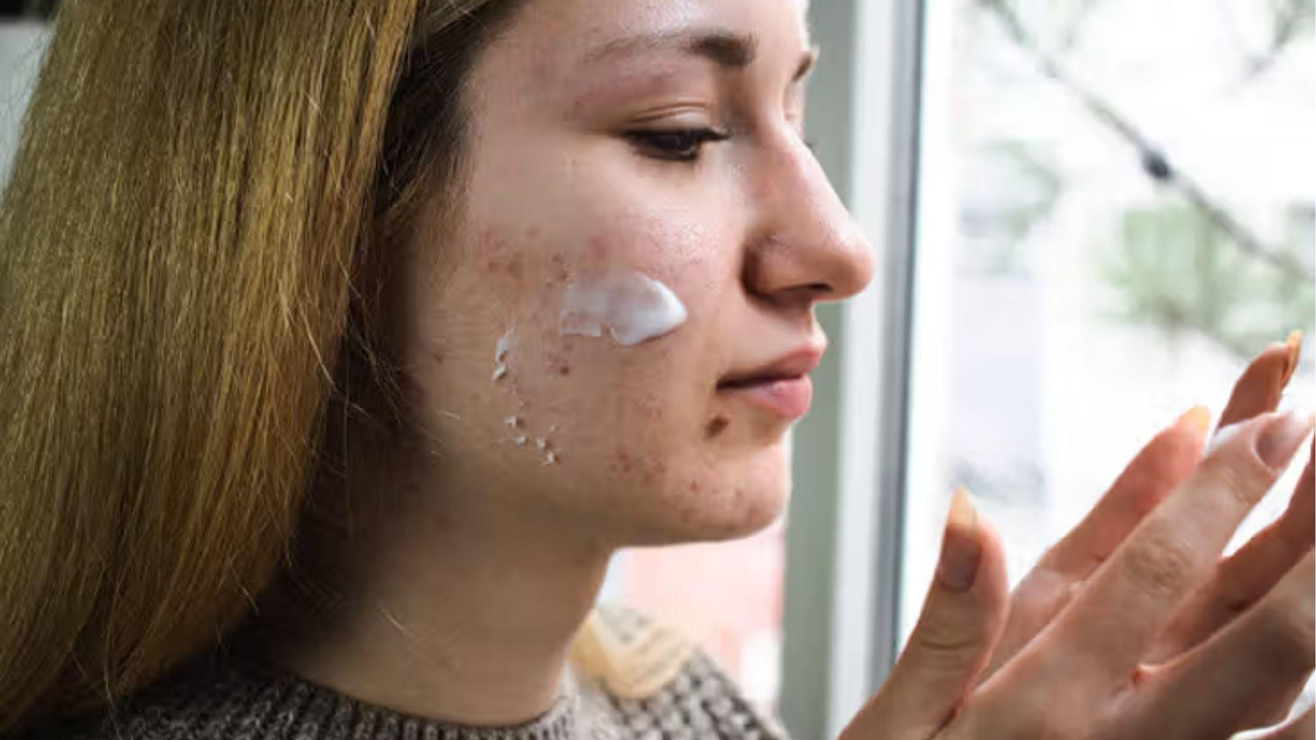 Woman applies acne cream to cheek breakouts by a window, showing skincare for stress-related acne.