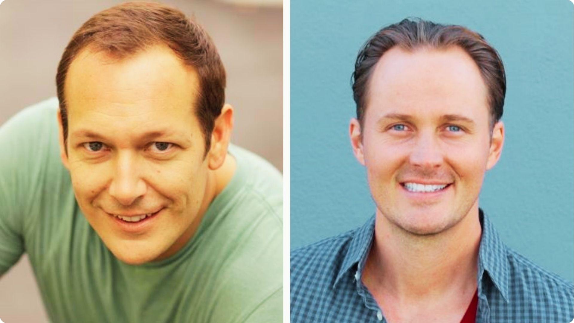 Split image comparing two men: left shows advanced temple recession, right shows a fuller hairline.