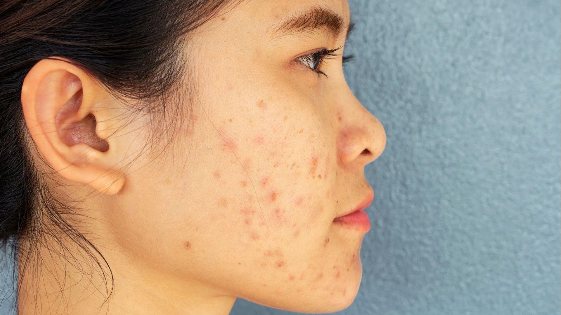 Close-up of cheek showing deep pitted acne scars and uneven skin texture before scar reduction treatment