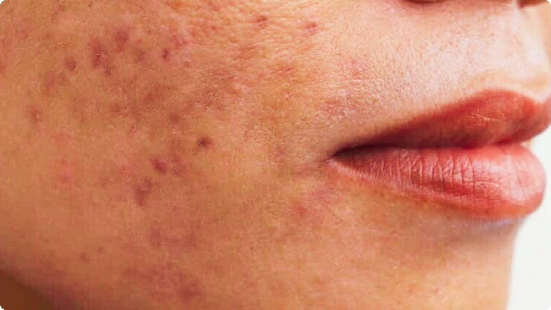 Close-up of a person’s lower face showing red-brown spots and post-inflammatory marks on the cheek near the lips.