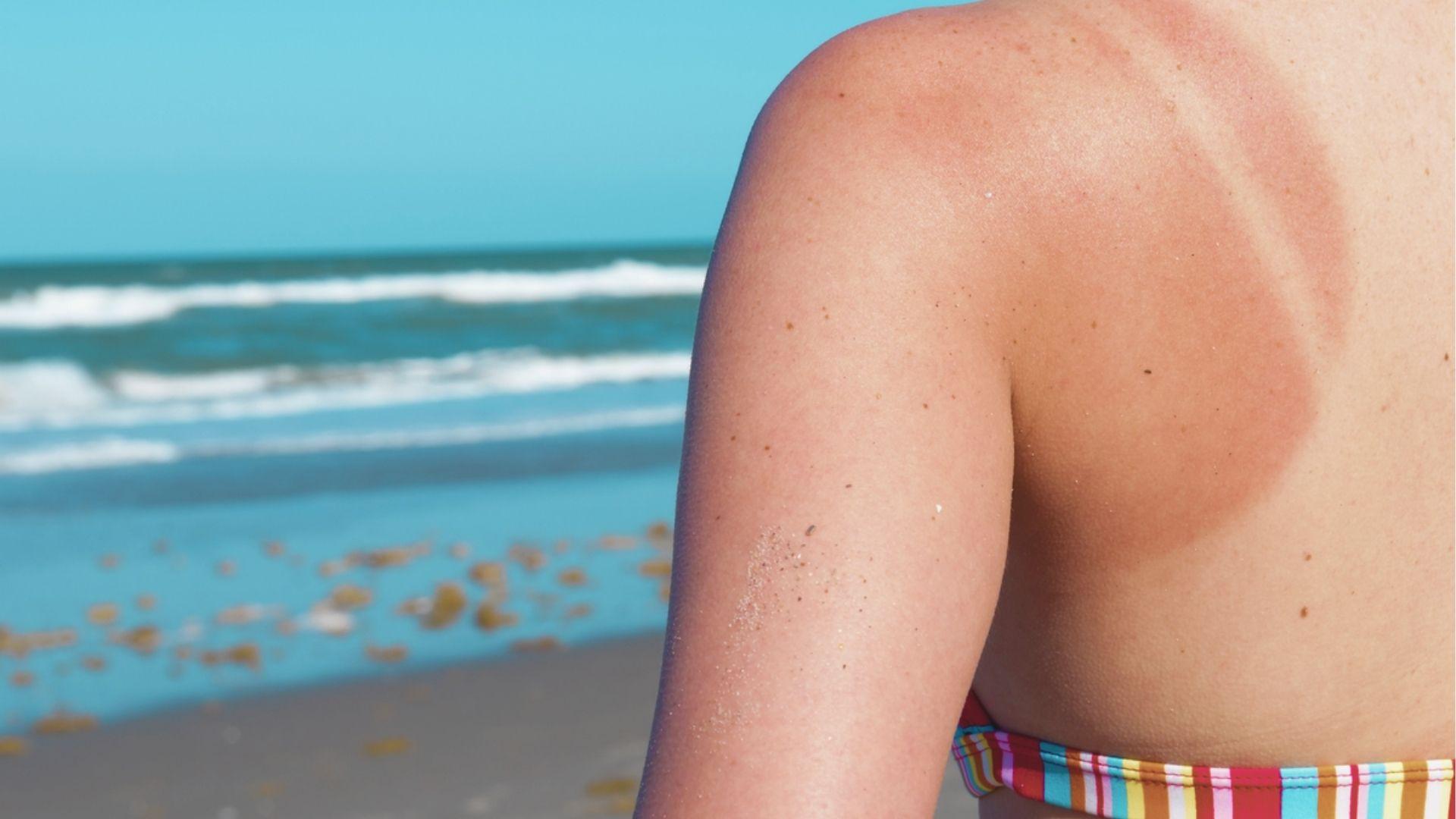 Close-up of a woman’s sunburned shoulder and back at the beach showing red skin and tan lines.