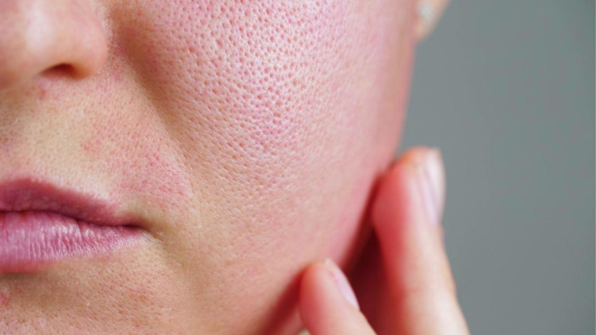 Close-up of cheek with visible large pores and slight redness showing dehydrated skin texture that feels tight after cleansing.