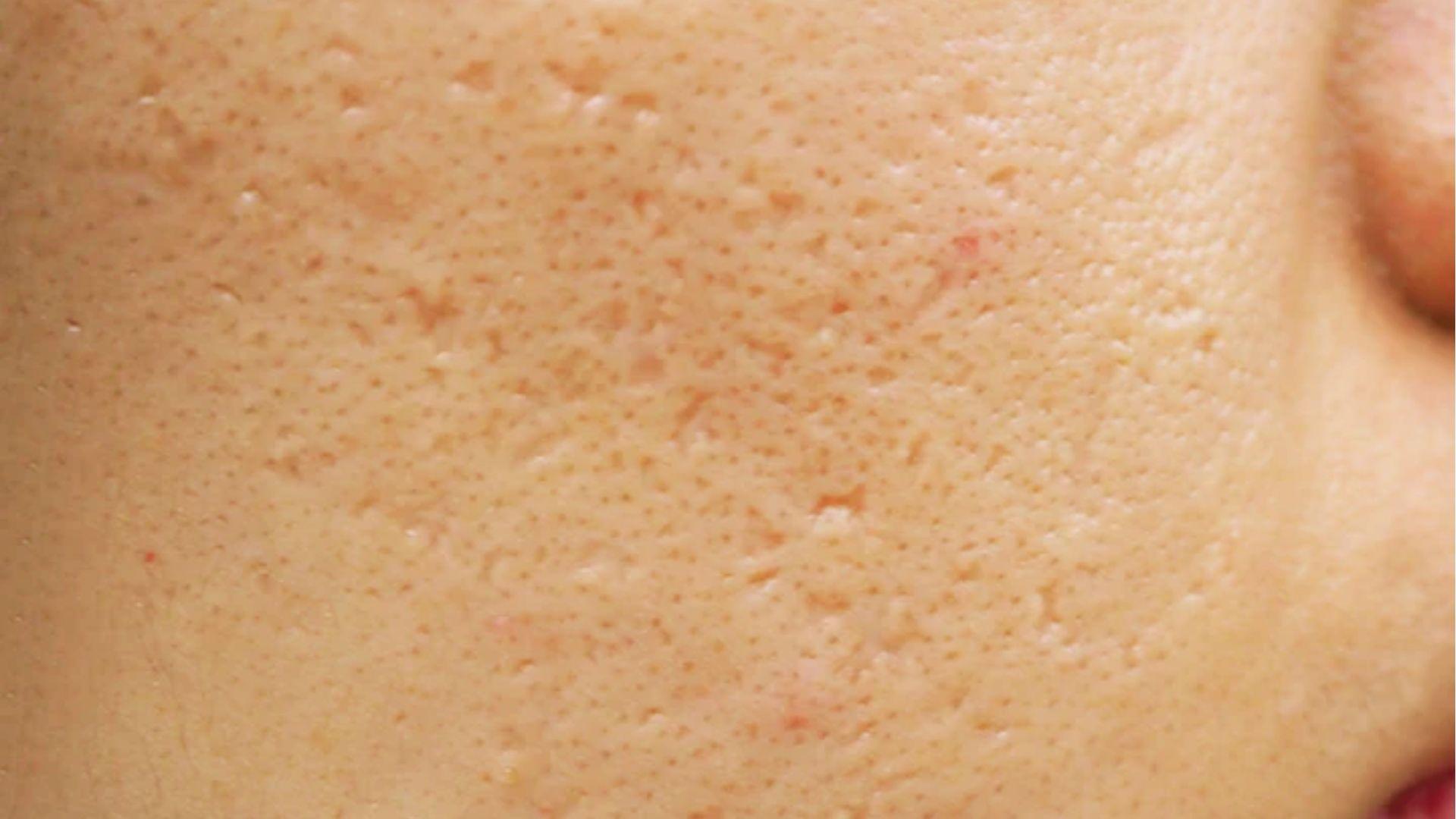 Extreme close-up of cheek with ice pick and boxcar acne scars, showing uneven skin texture needing treatment