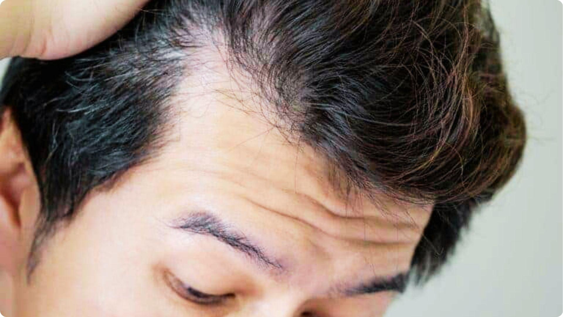 Close-up of a man's forehead as he pulls back hair, revealing deep temple recession.