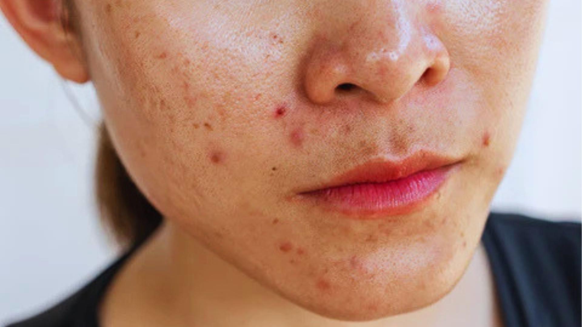 Close-up of lower face showing oily skin with acne, pimples, and blemishes on cheeks and chin for skincare content.