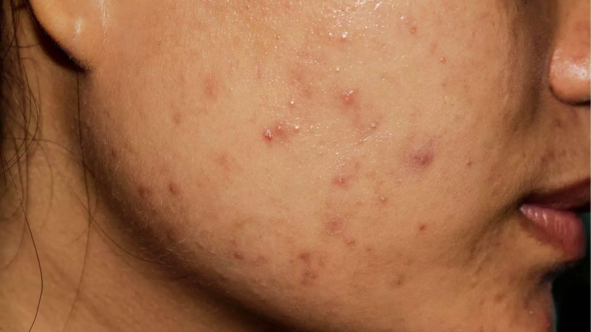 Close-up of cheek with active acne, red pimples, and post-inflammatory dark spots needing scar fading treatment.