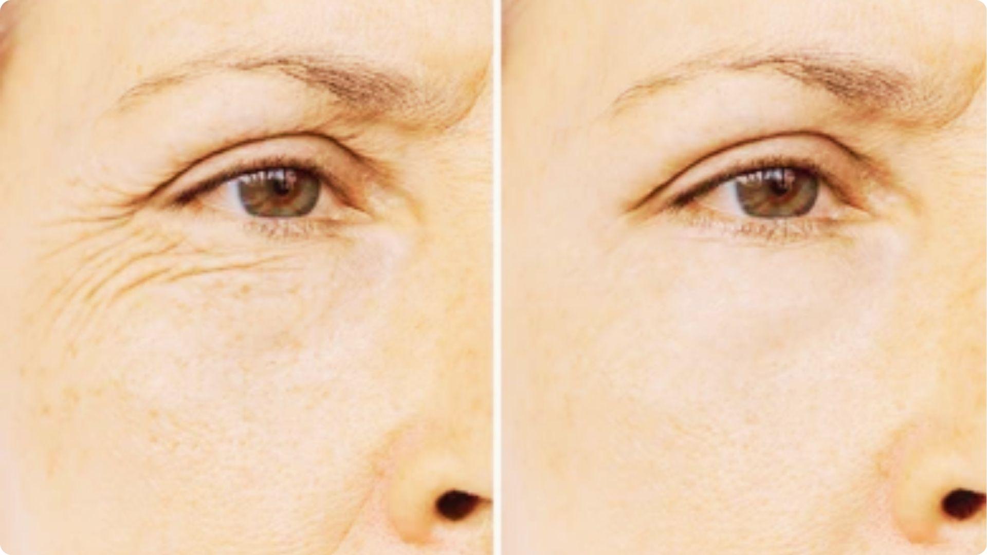 Close-up before and after comparison of the eye area showing reduction in fine lines and crow’s feet.