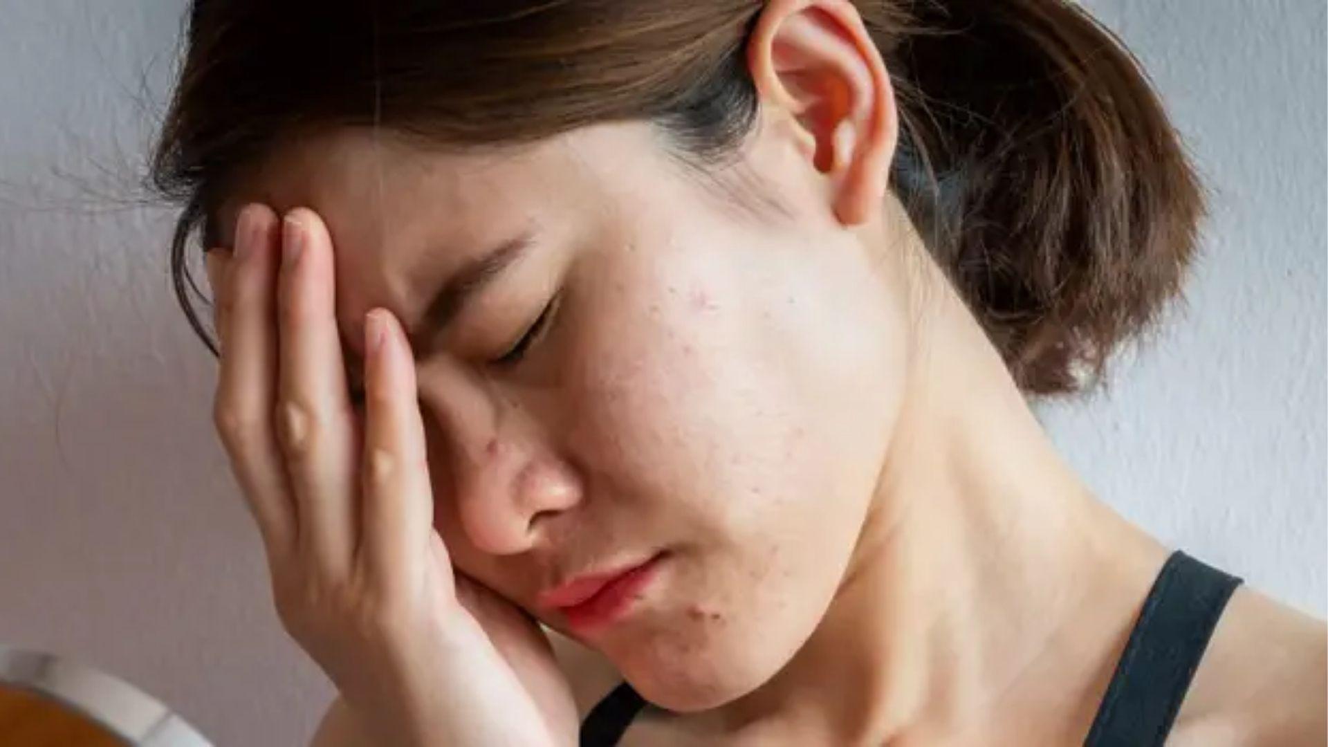 The woman holds her head in stress with visible acne, showing the emotional toll stress breakouts can cause.
