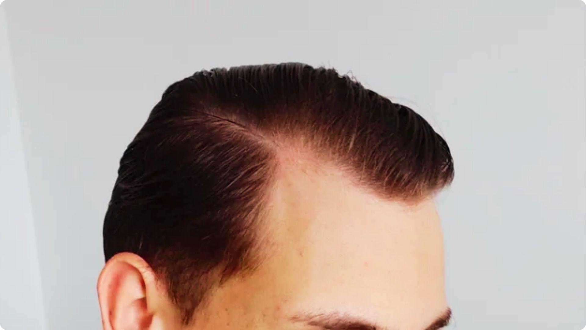 Side view of a man's head with slicked-back hair showing a defined widow's peak.