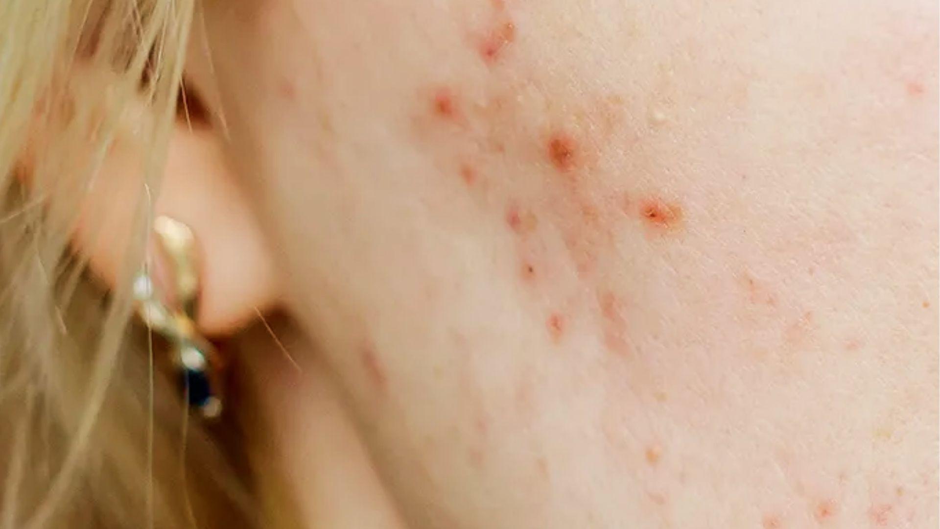 Close-up of cheek with active acne, red pimples, and post-inflammatory dark spots needing scar fading treatment.
