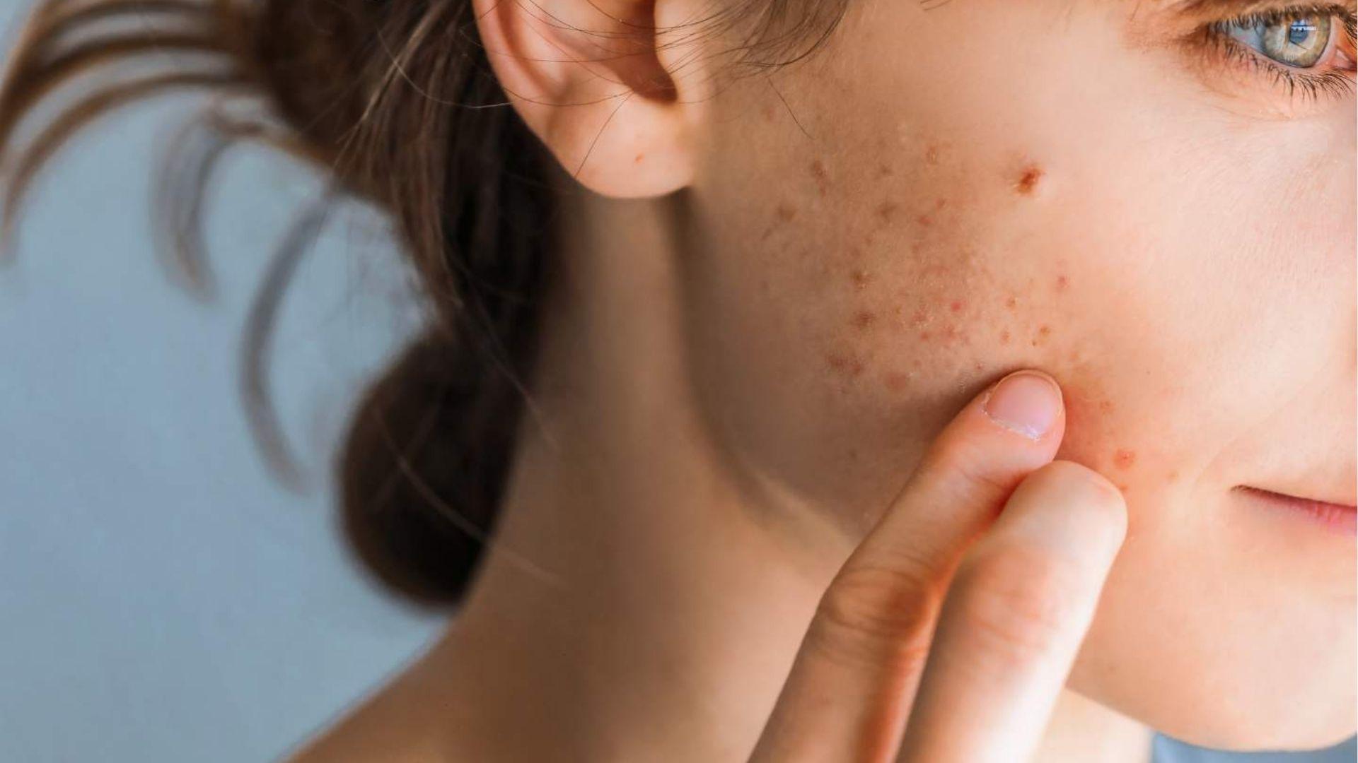 The woman touches the acne-prone cheek with one finger, highlighting how stress can worsen skin inflammation.