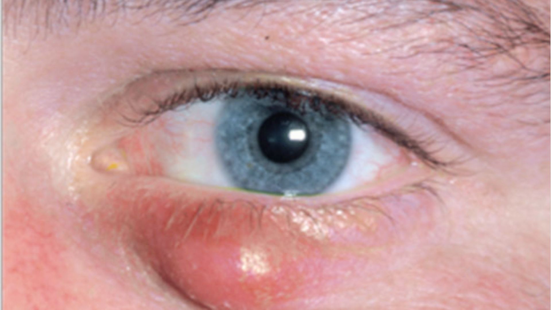close-up of a person showing Under-Eye Cysts