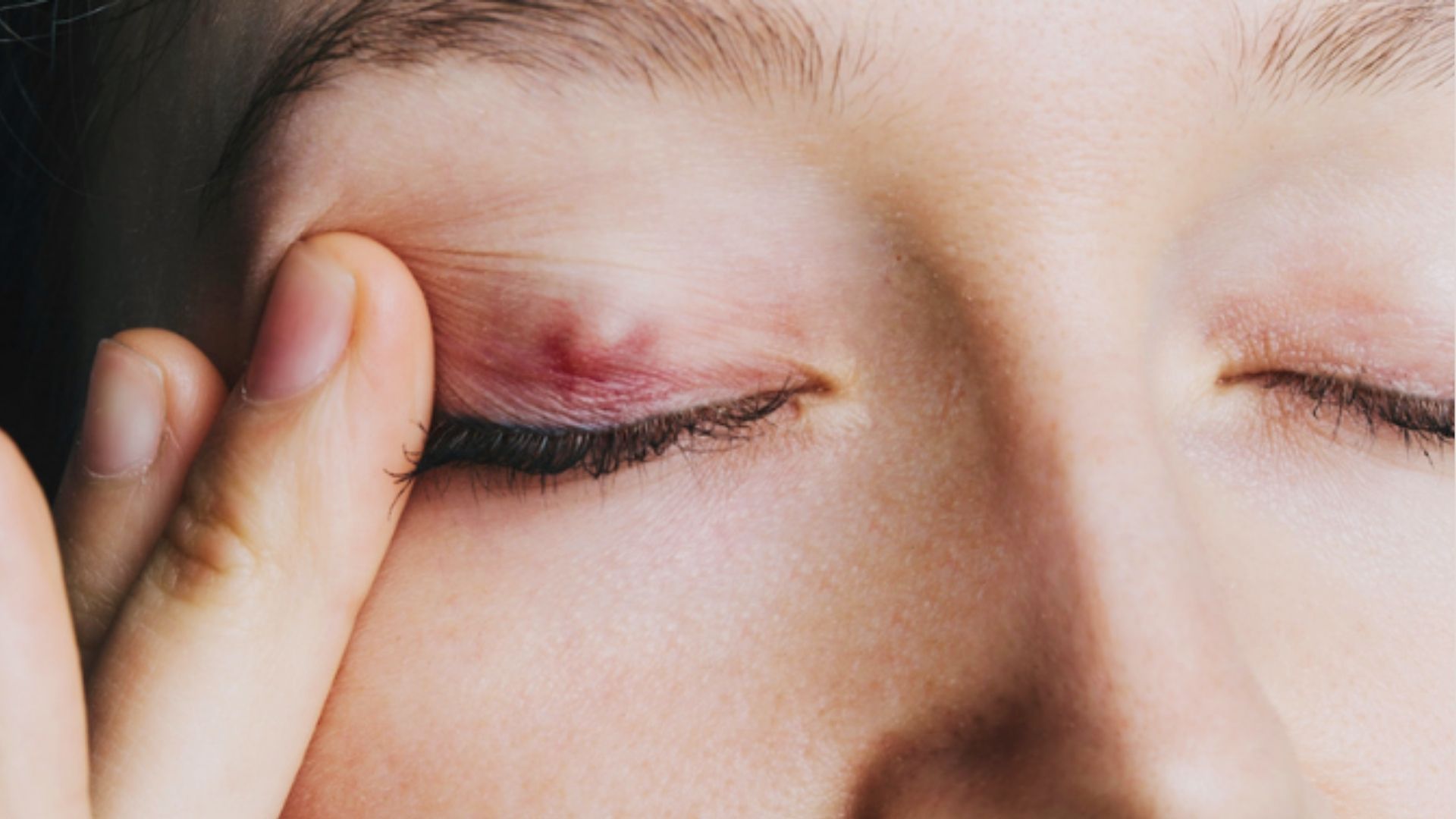 close-up of a person showing Chalazion