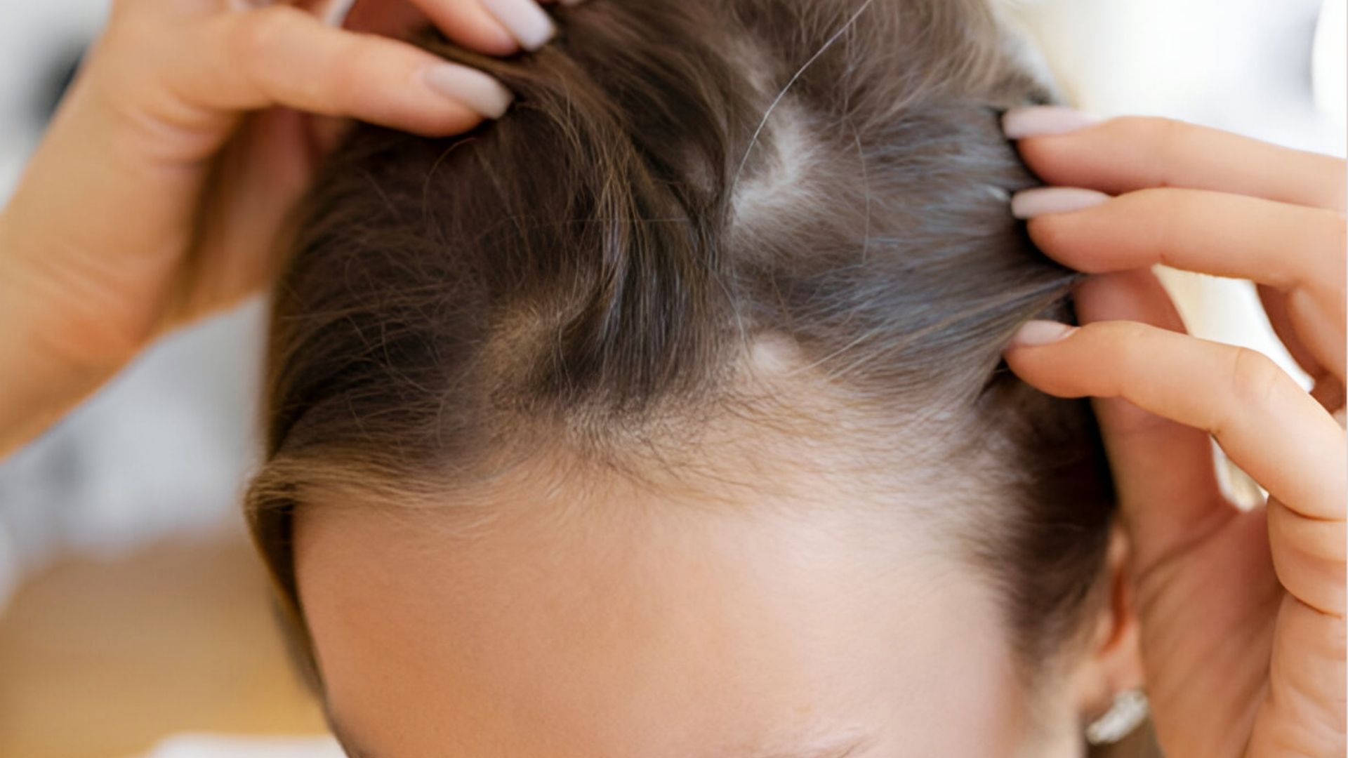 She is showing Early hair regrowth progress with healthier scalp and reduced shedding during the first 3 weeks.