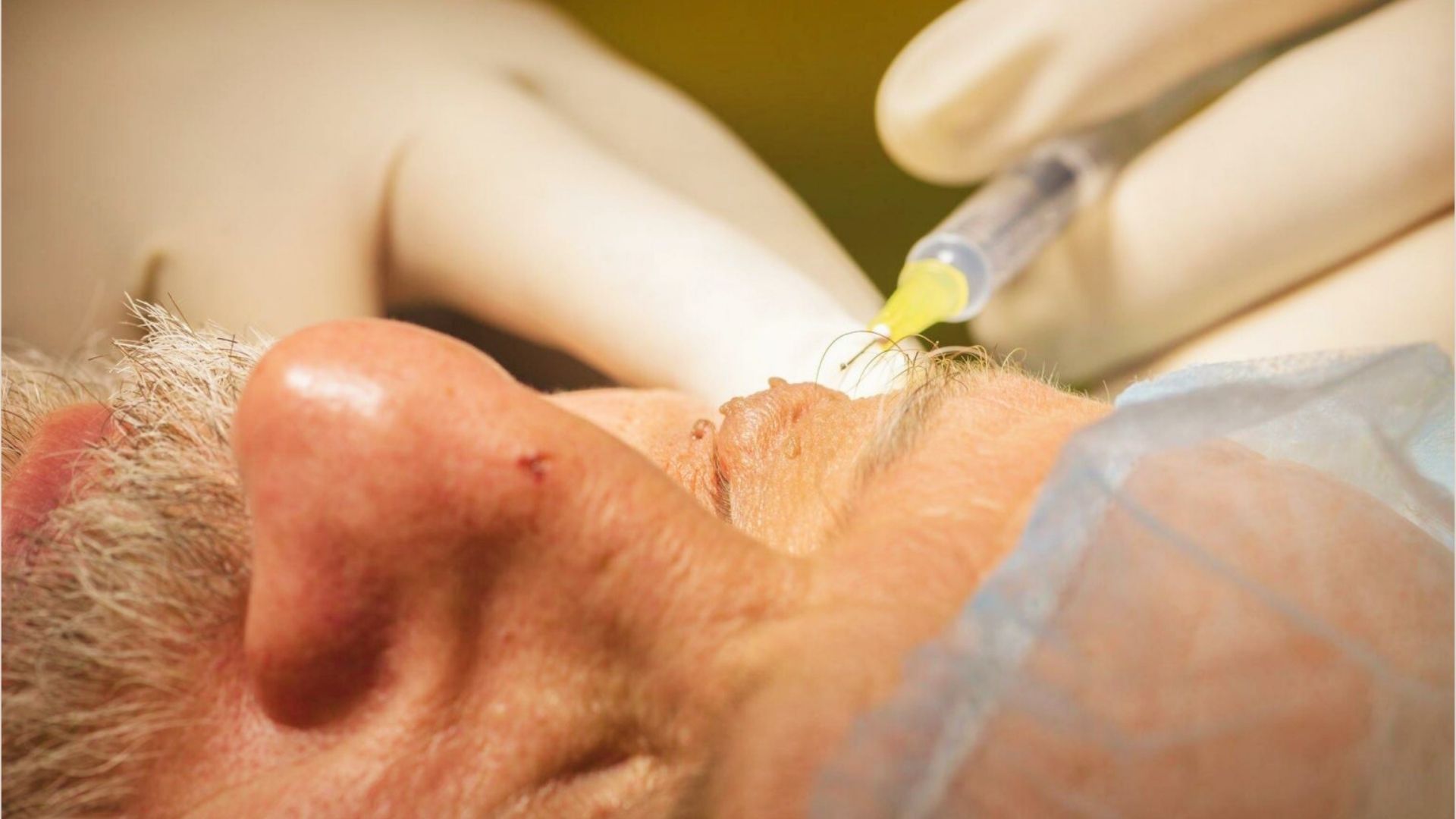 Cortisone injection used by a doctor to reduce swelling and inflammation of an under-eye bump.