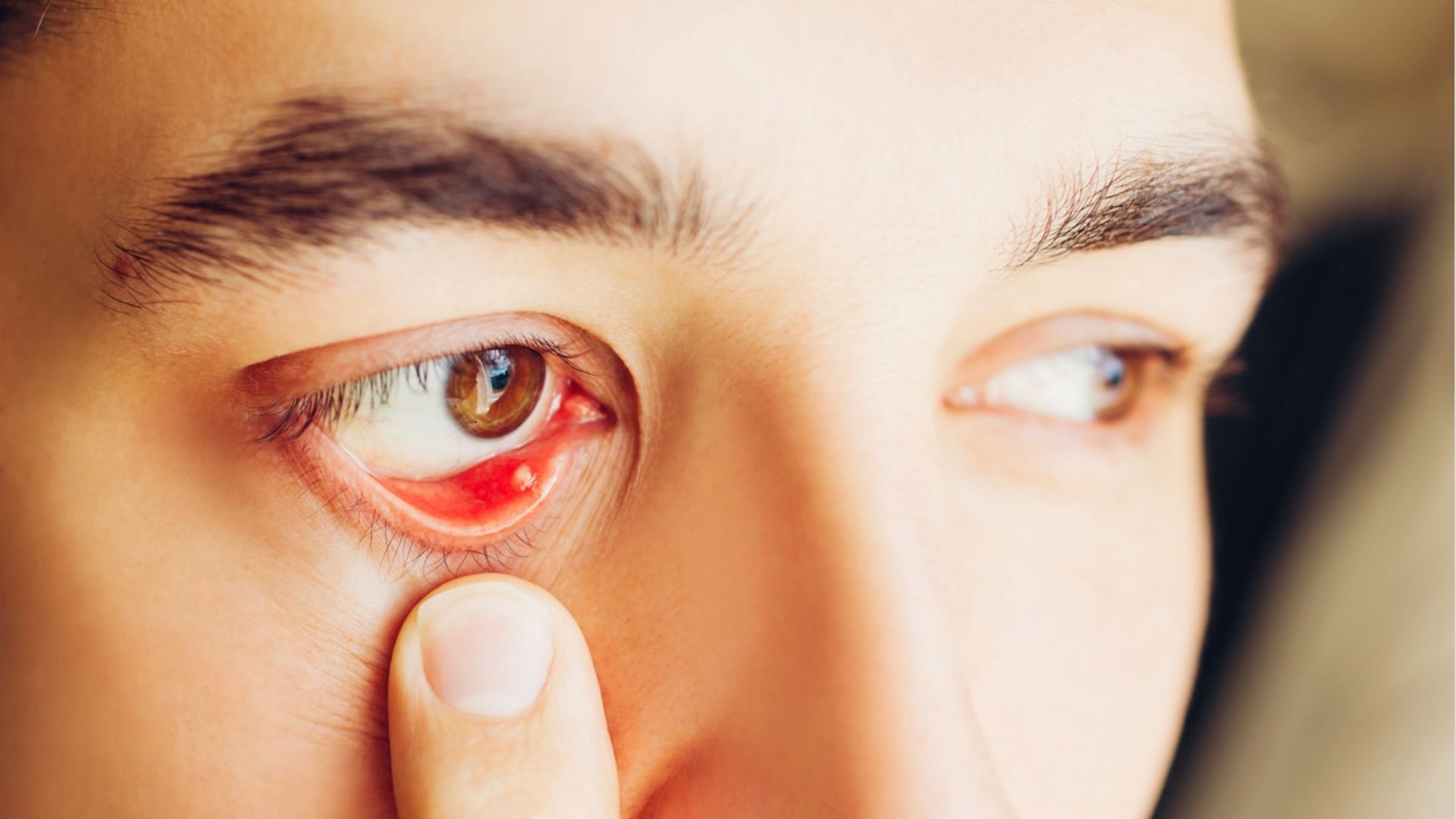close-up of a person showing Stye (Red Bump Under Eye)