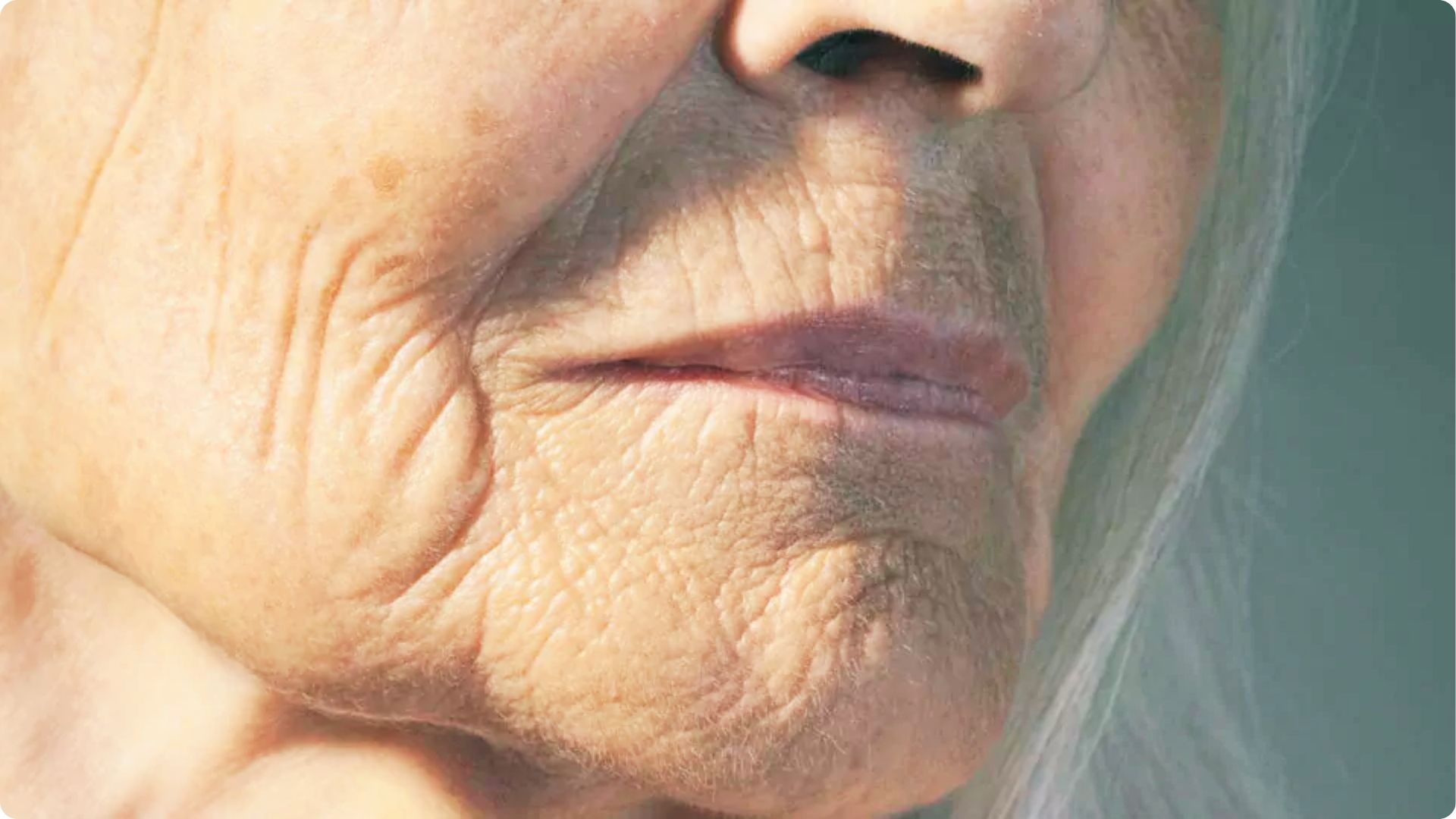 Close-up of an older person’s lower face and chin showing deep wrinkles and crepey skin texture.