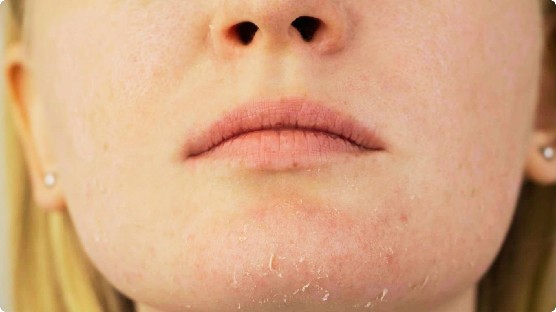 Close-up of a woman's lower face showing dry, flaky skin on the chin and around the mouth.