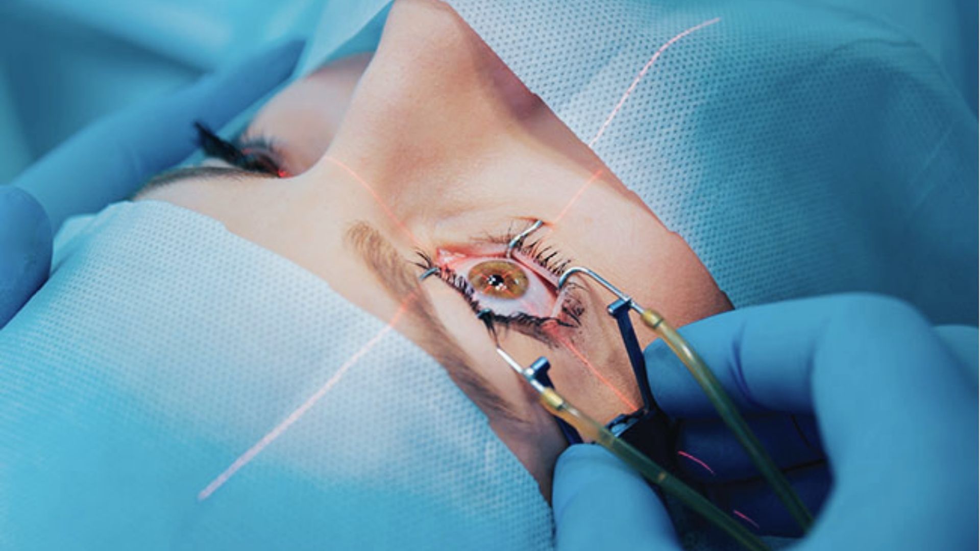 Surgical removal of a recurring under-eye cyst performed by a dermatologist for permanent treatment.